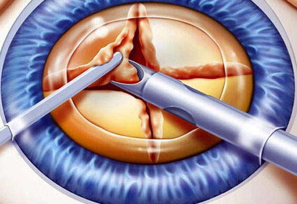 Cataract surgery for a diabetic patient
