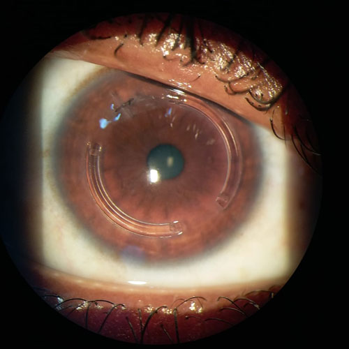 Keratoconus-managment