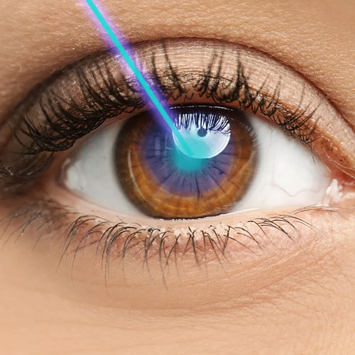 eye lasik surgery in hyderabad